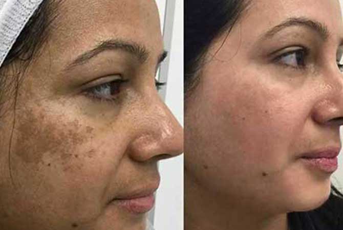 Depigmentation treatment result before after